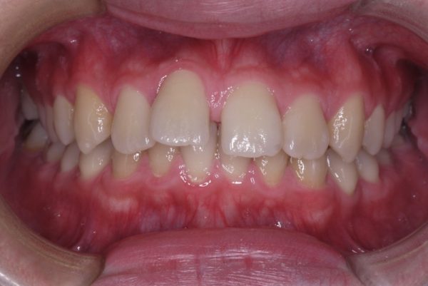 case-1-before-600x401 (1)