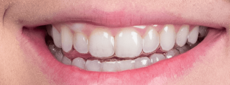 clear-aligners